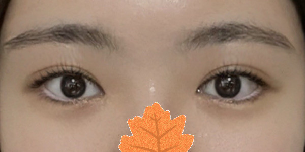 My in-out line double-eyelid surgery was a success! hahaha