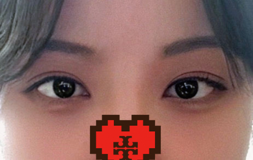 Escaped the gyopo look with dual canthoplasty and revision eye surgery