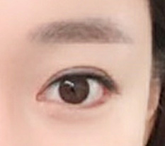 I had revision canthoplasty at Hyundai Aesthetic Surgery, the best~