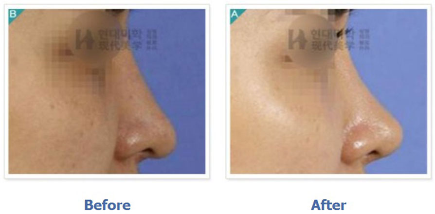 Rhinoplasty