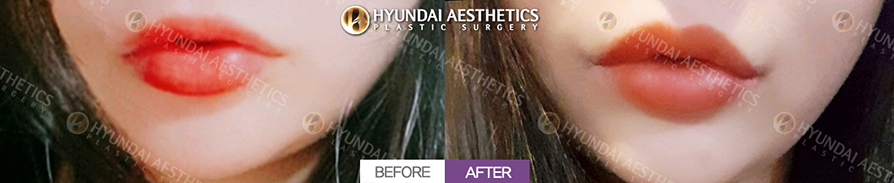 Mouth Corner Lift + Marionette Lines