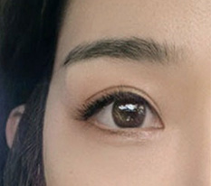 It was my last chance and the eye revision surgery finally succeeded ㅎ
