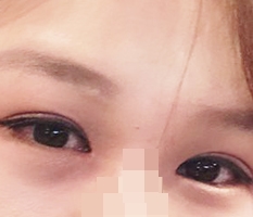 Incision, ptosis correction, epicanthoplasty, dual canthoplasty