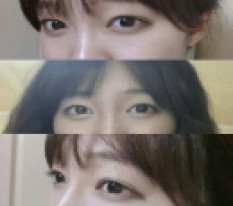 I worried a lot about revision surgery.. now I have confident, pretty eyes ♥