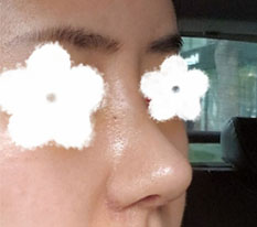 I had revision nose surgery thinking it would be the last time