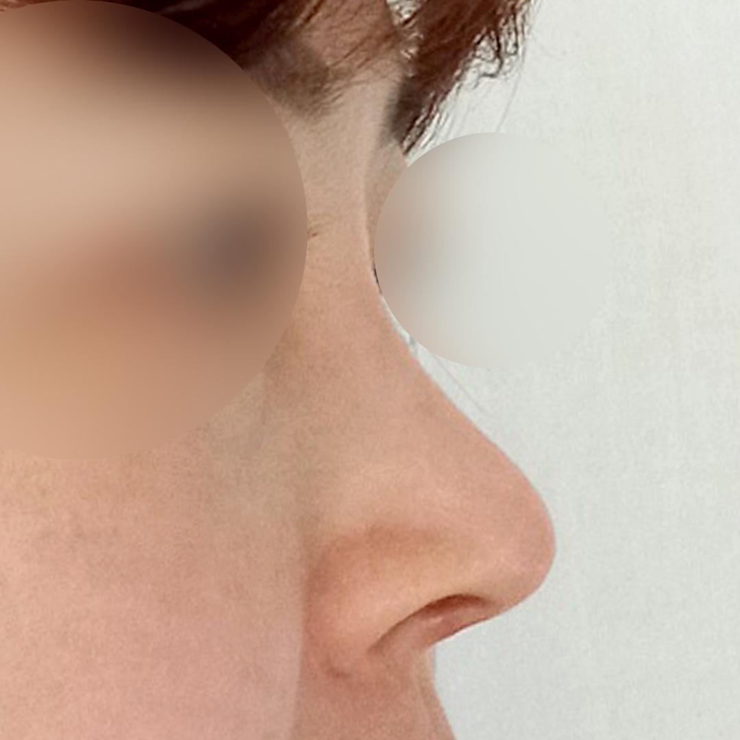 I saved up and got rhinoplasty at Hyundai Aesthetic Surgery