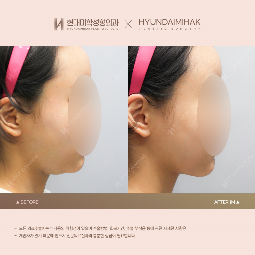 [Lifting] Double-Chin Thread Lift, 1 Month Post-Op