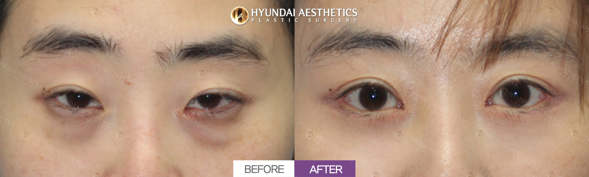 Revision eye surgery (incisional ptosis correction, double eyelid surgery) + epicanthoplasty + lateral canthoplasty + lower canthoplasty, 1 month