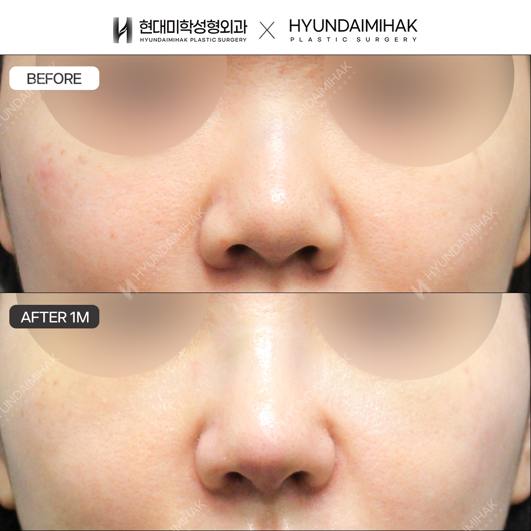 [Bulbous Nose Surgery] Bridge + Tip, 1 Month