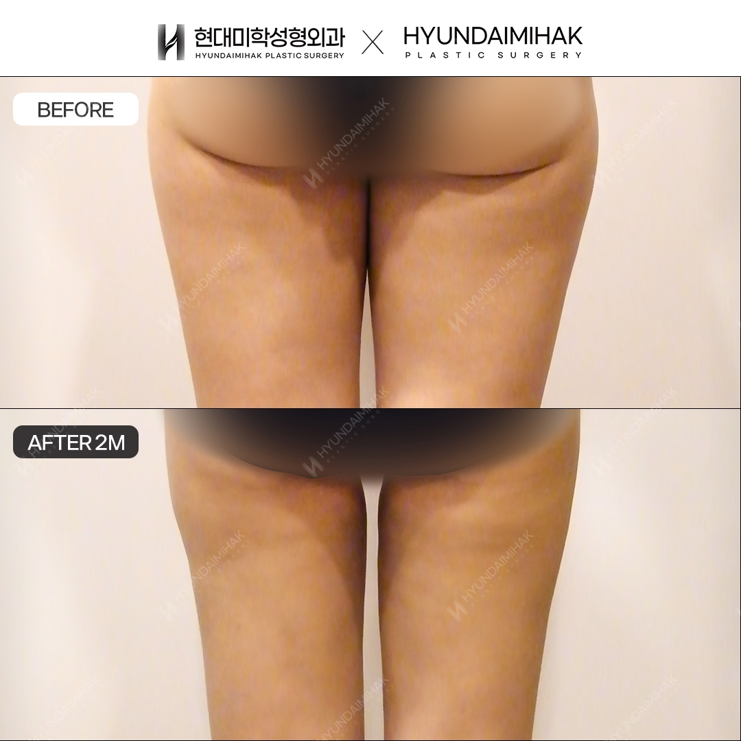 2 months after thigh liposuction