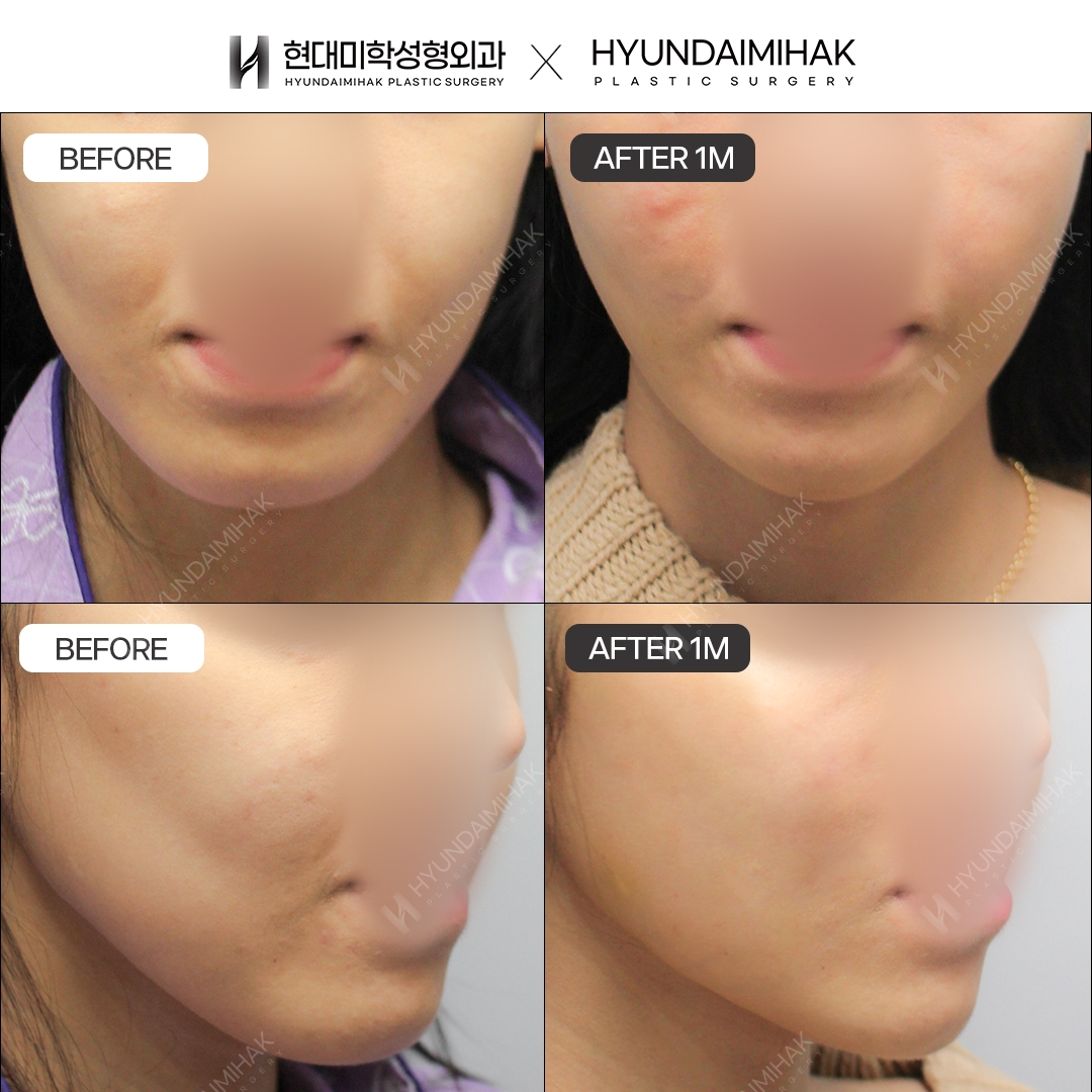 [Anti-Aging Surgery] Thread Lift, 1 Month