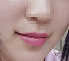 Posting my review of mouth-corner surgery~