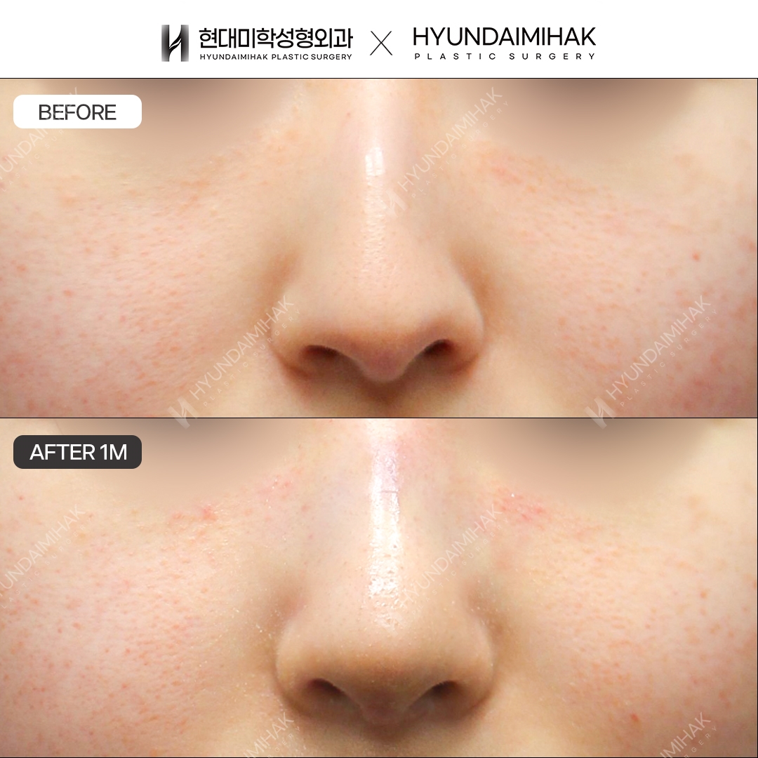[Hump Nose Surgery] Nasal bridge + nasal tip, 1 month post-op