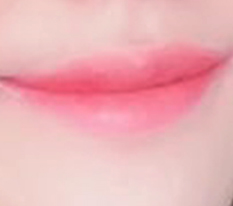 All thanks to lip corner surgery