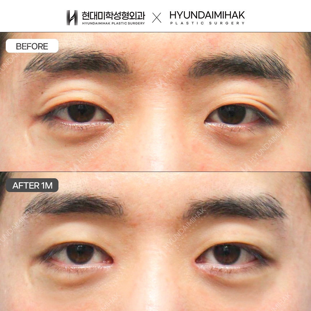 [Male Eye Surgery] Non-Incisional Ptosis Correction + Medial Epicanthoplasty