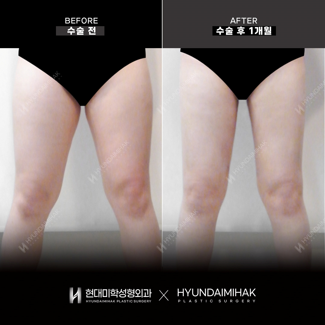 Thigh liposuction, 1 month after surgery