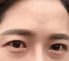 I had double eyelid surgery and eye-shape correction.