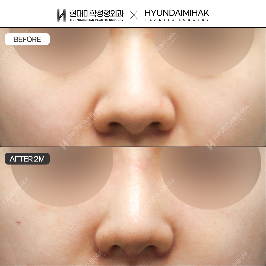 [Bulbous nose rhinoplasty] Nasal bridge + nasal tip, 2 months post-op