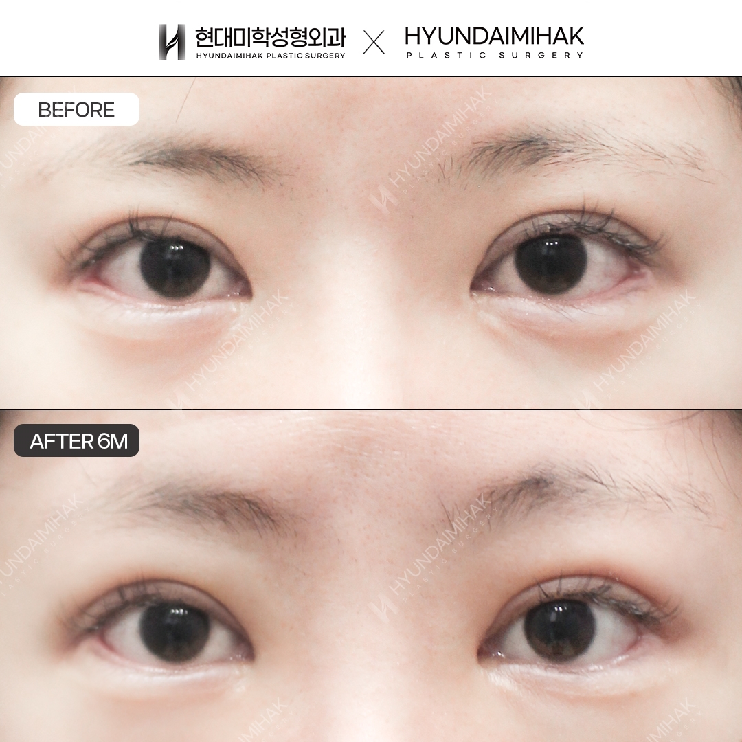 [Revision Eye Surgery] Lower Lateral Canthoplasty Restoration