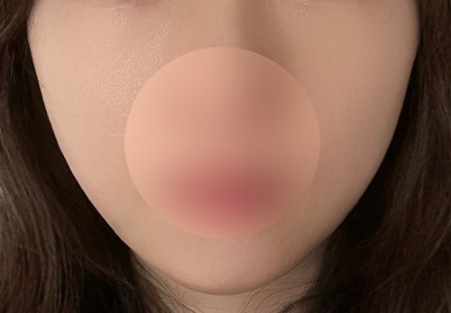 Thread lifting for sagging cheek fat