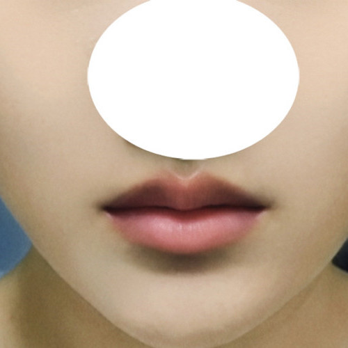 Concern about my thick upper lip, solved with a Cupid line