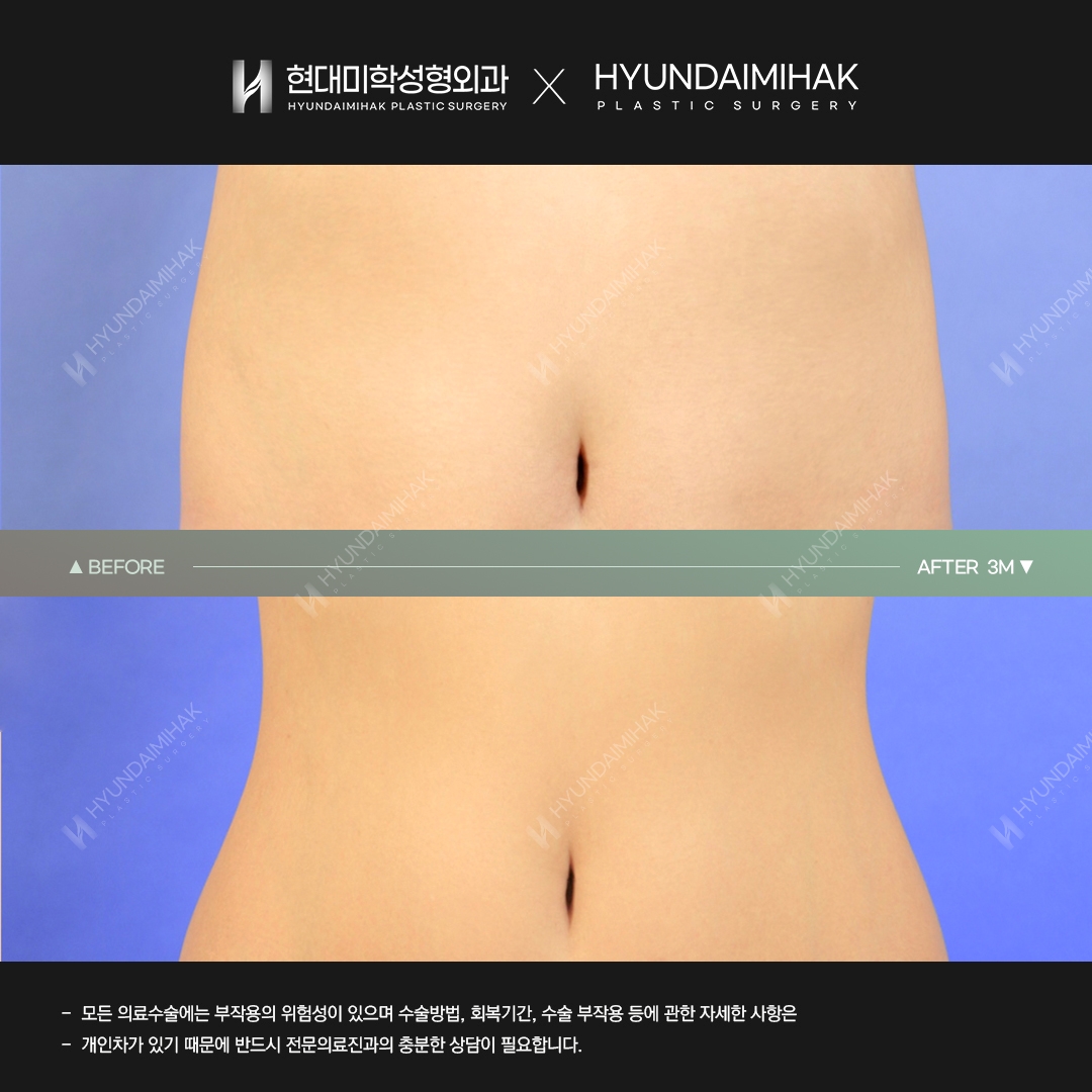 Abdominal liposuction, 3 months post-op