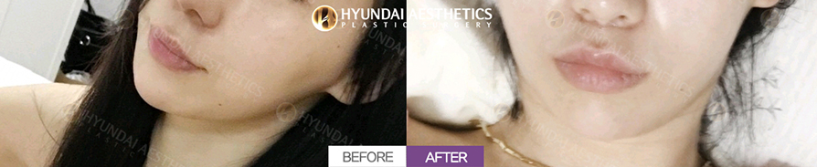 Lip Surgery + Philtrum Reduction