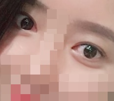 Eye revision + ptosis correction