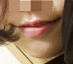I really think I did well getting mouth-corner surgery at Hyundai Aesthetic Surgery lol