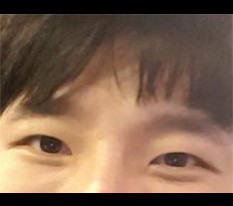 Eye surgery review ㅋ