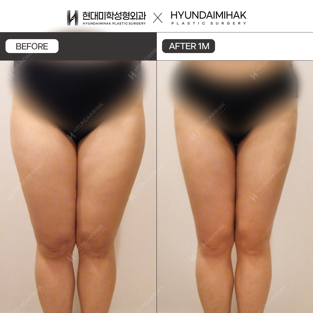 Thigh liposuction, 1 month after surgery