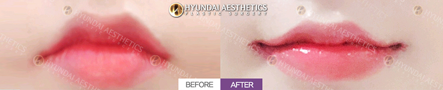 Mouth Corner Lift + Marionette Lines
