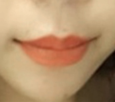 The mouth-corner surgery I was most satisfied with :-)