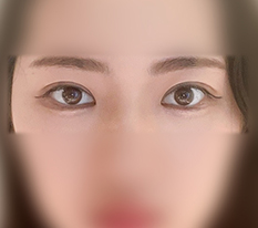My uneven eyes were balanced ㅋㅋ