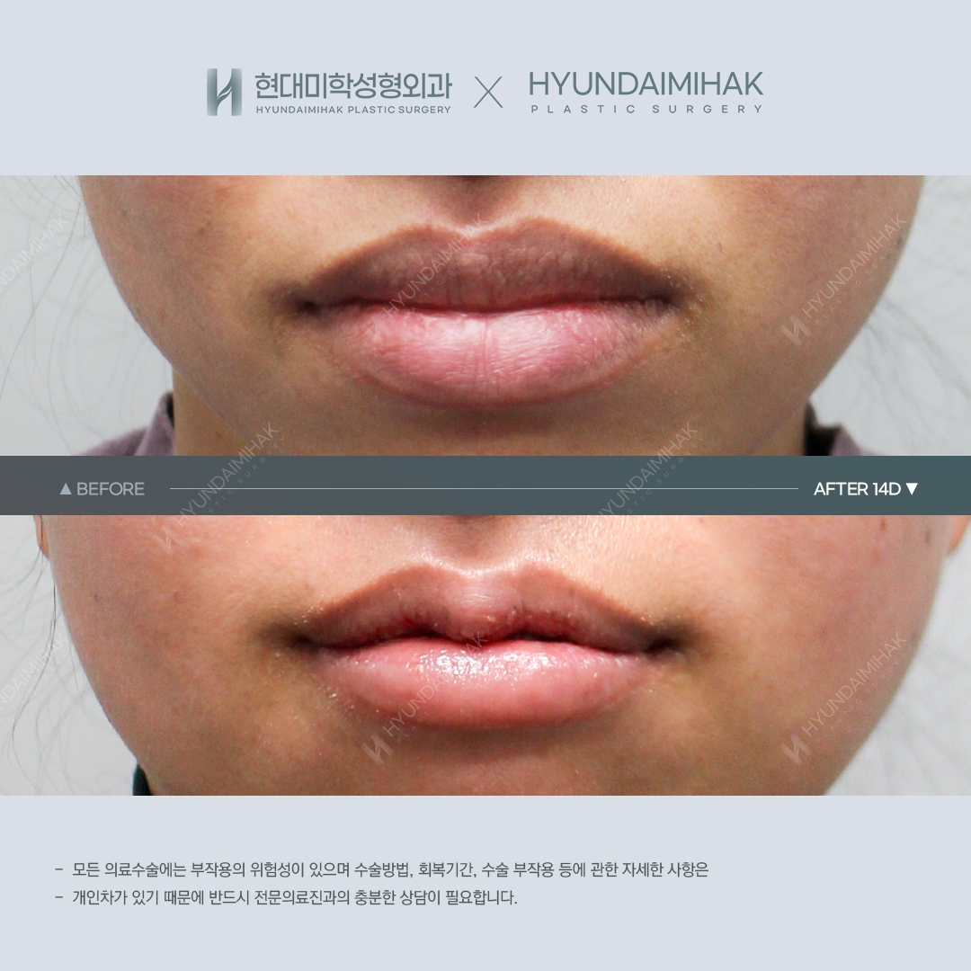 [Lip Surgery] Cupid's Bow Line and Lip Reduction, 14 Days