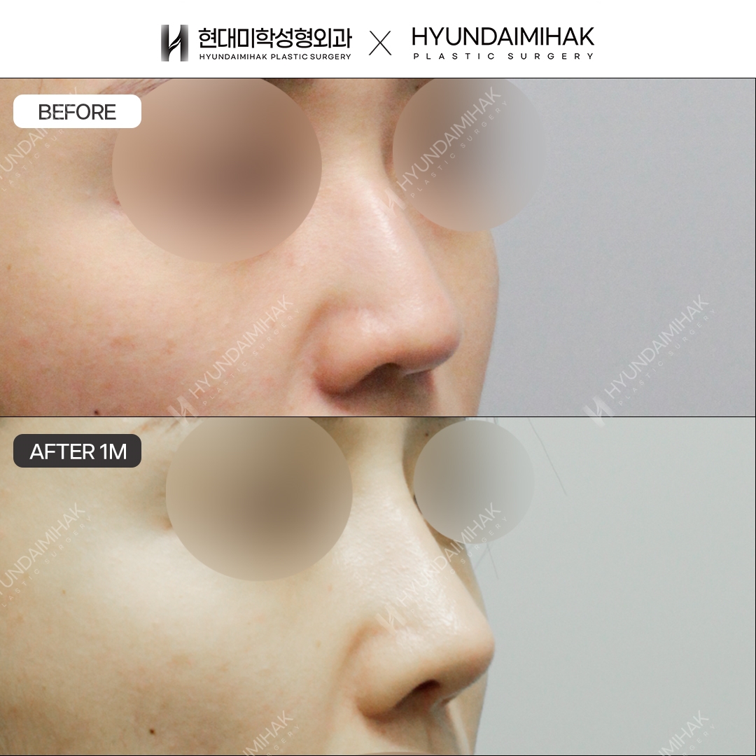 [Hump Nose Surgery] Bridge + Tip, 1 Month
