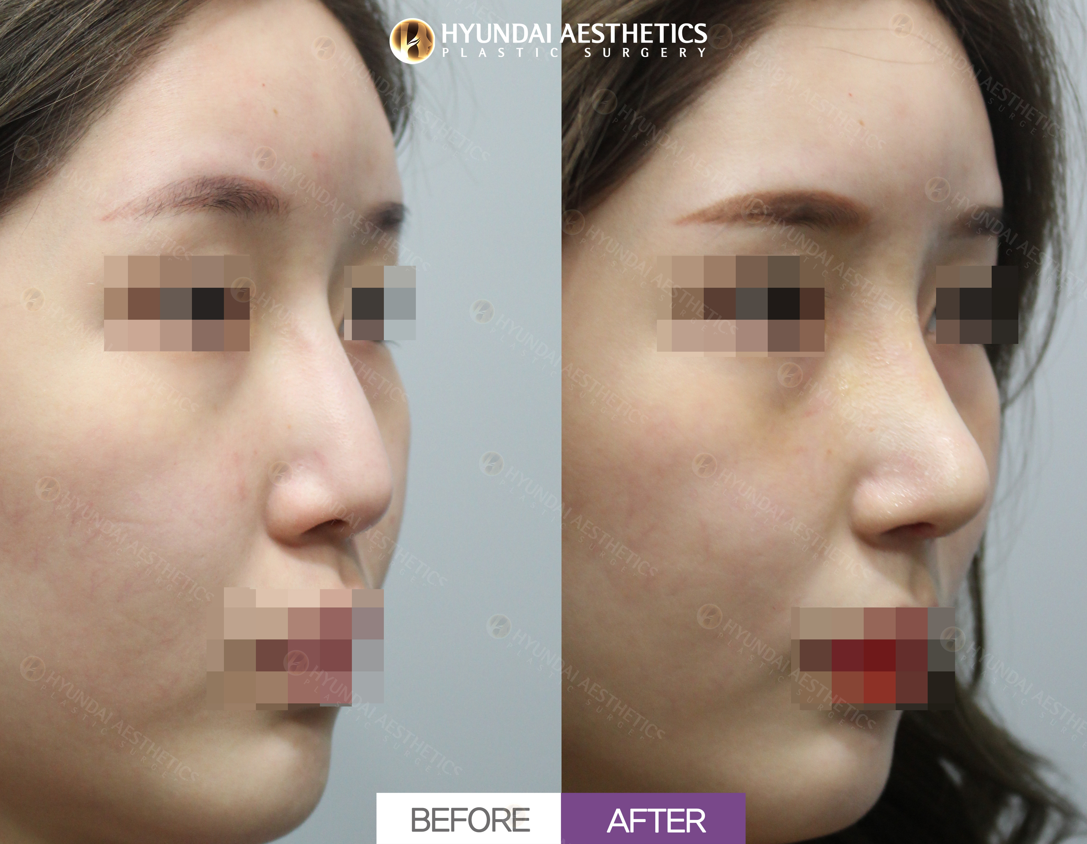 Revision Rhinoplasty, 1 Month