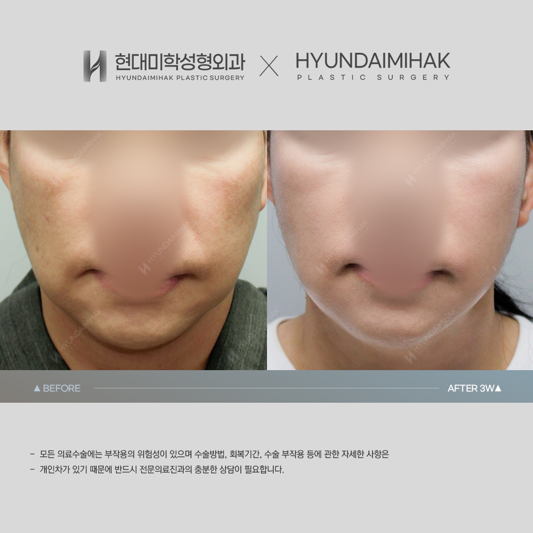 [Anti-aging Surgery] Thread lift, 3 weeks