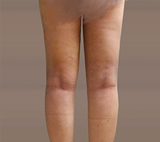 Why did I only get liposuction now ㅠ