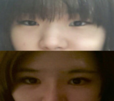 I Successfully Changed My Image with Eye and Nose Surgery :)