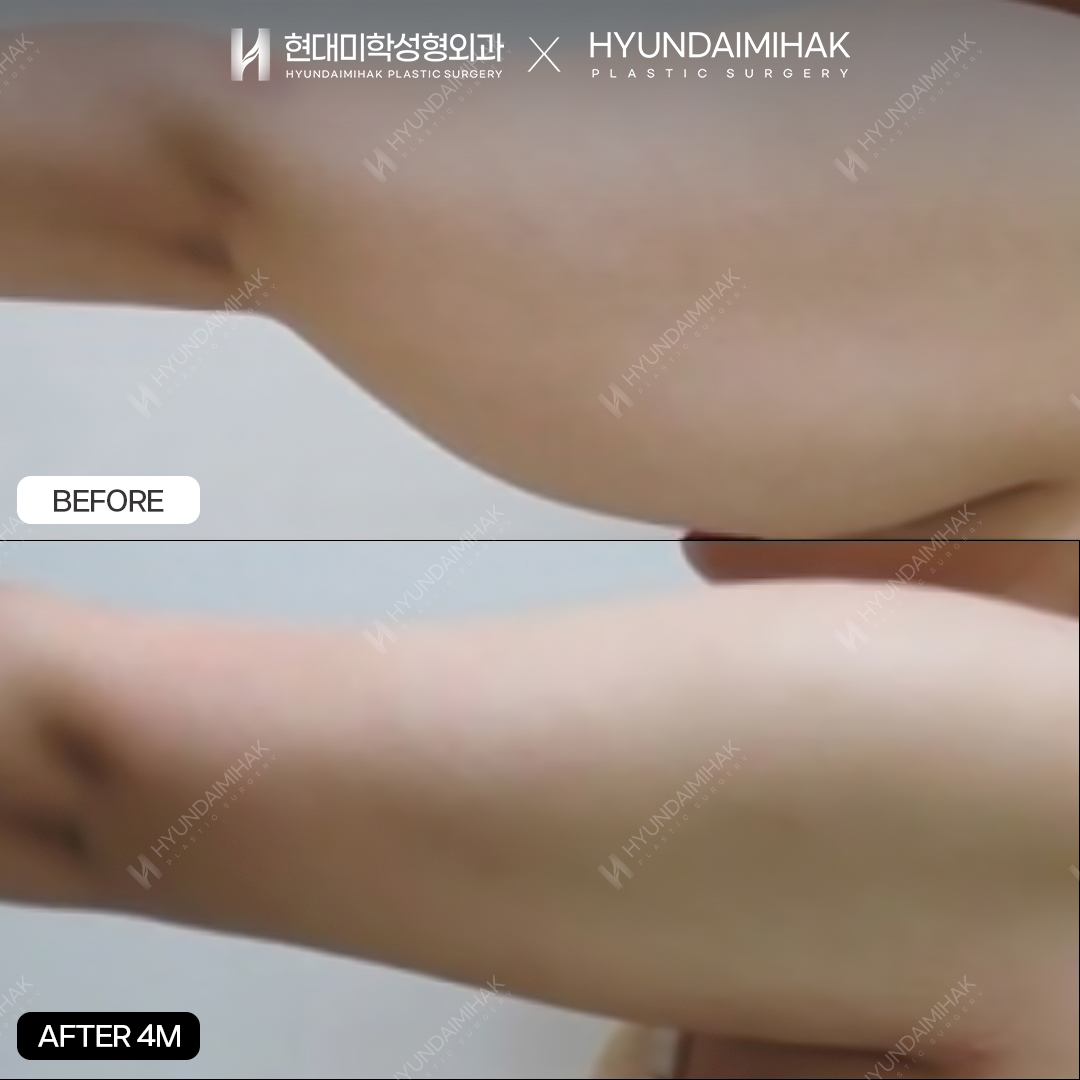 Arm Liposuction, 4 Months Later