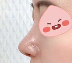 Two weeks after my nose revision and I'm already loving it ㅎㅎ