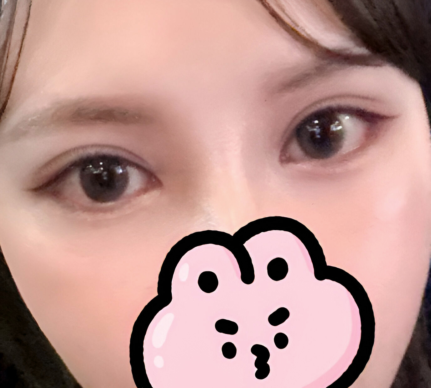 Revision eye surgery with a semi-out line💗
