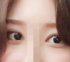 I admit it — Hyundai Aesthetic Surgery is amazing at eye surgery *=_=*!!!