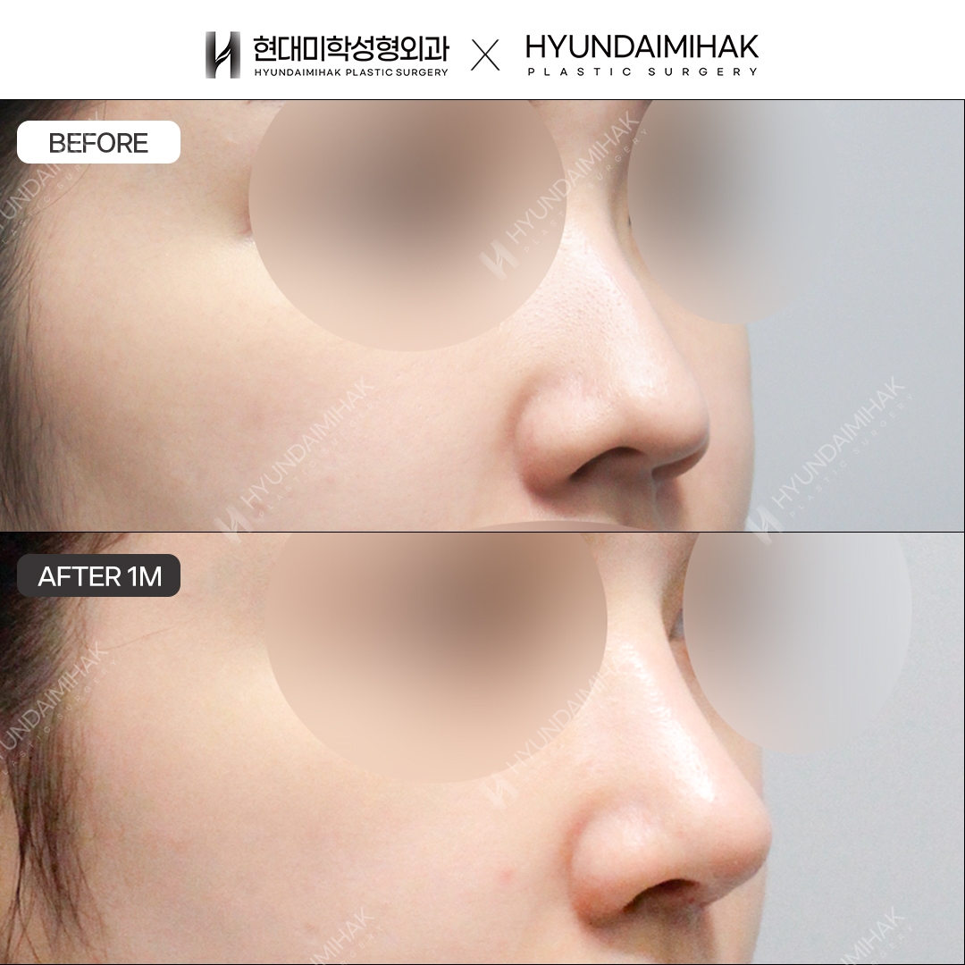 [Hump Nose Surgery] Bridge + Tip, 1 Month
