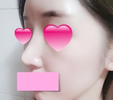 Revision rhinoplasty review~~