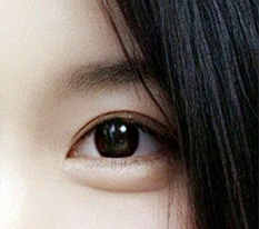 My eye revision surgery was a success, right?? ㅎㅎ