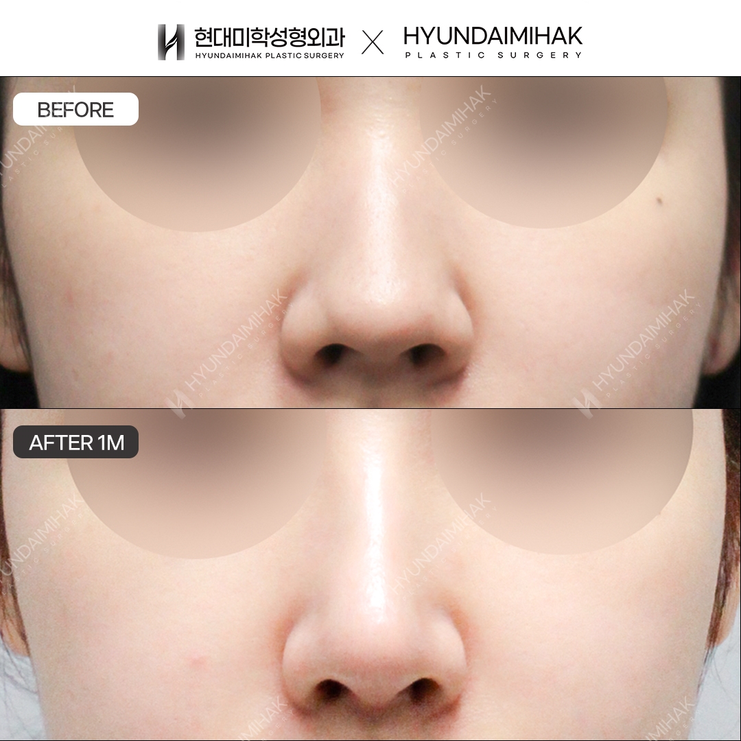 [Hump Nose Surgery] Bridge + Tip, 1 Month