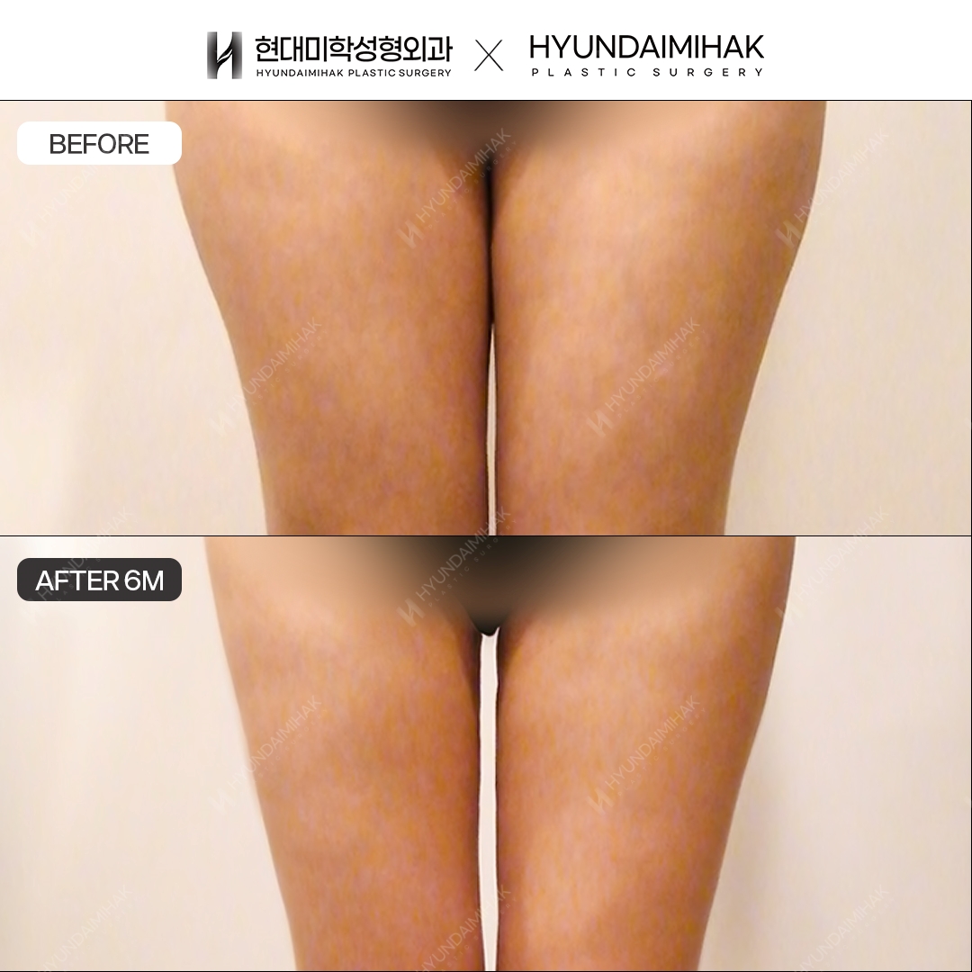 Thigh liposuction, 6 months post-op