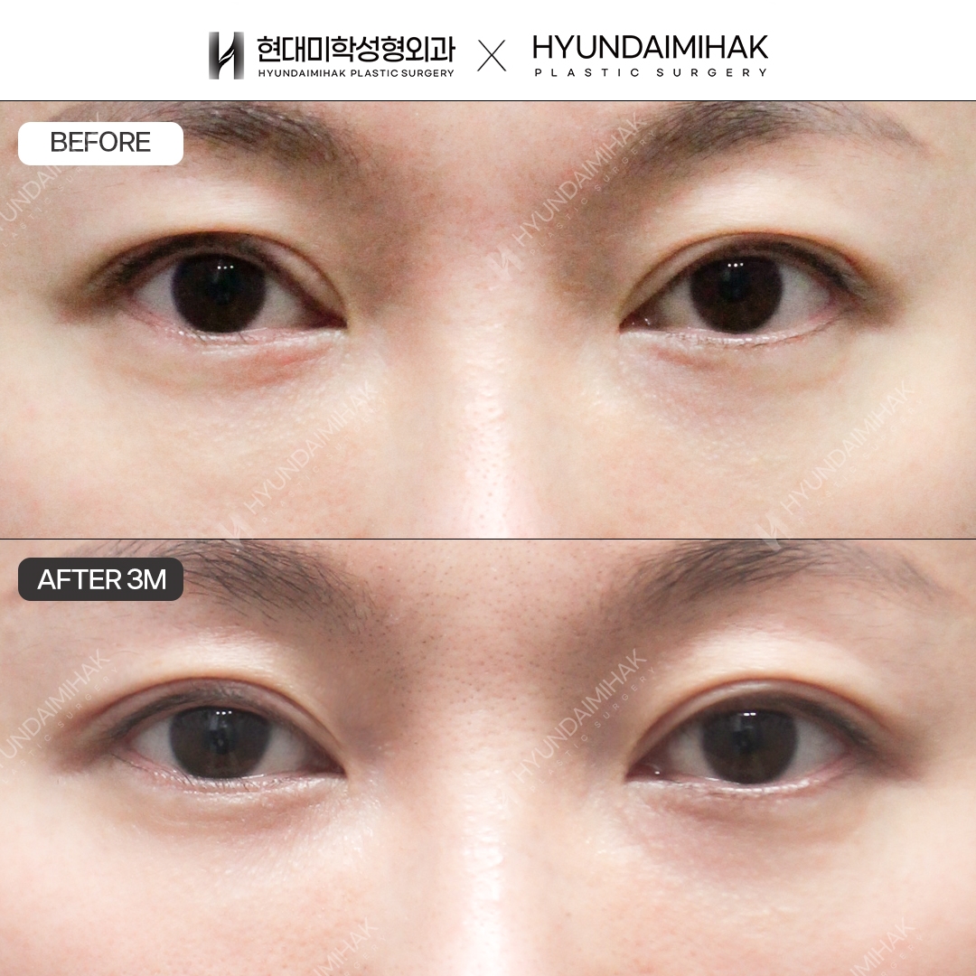 [Revision Eye Surgery] Incisional Double Eyelid + Ptosis Correction